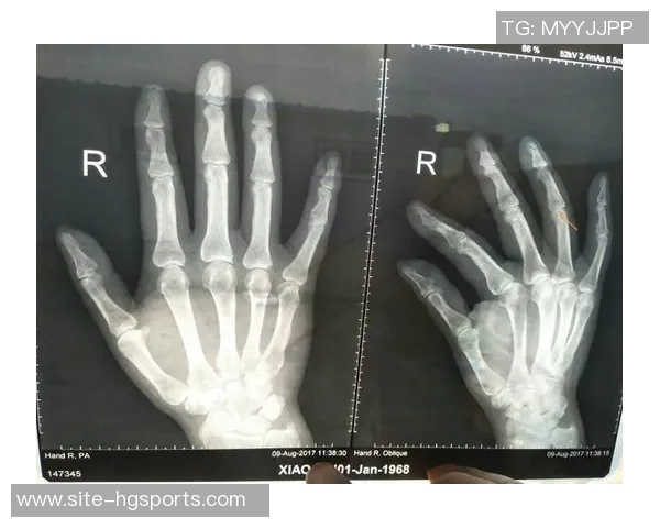 森林狼球员莱昂纳德米勒右手小拇指受伤两周后将进行复查 森林狼球员莱昂纳德米勒右手小拇指受伤两周后将进行复查